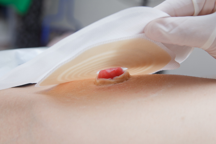 Injection / Perfusion, infirmiere calais, infirmière, piqure, diabète, trop de sucre dans le sang